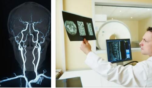 Что выявляет МР-ангиография вен головного мозга