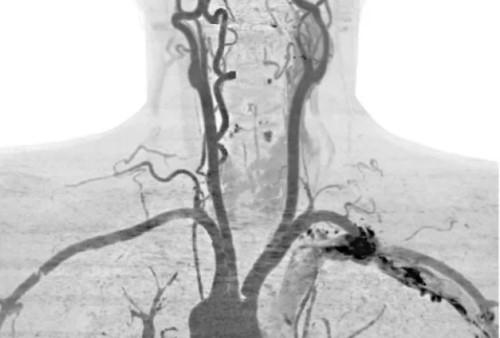 Что выявляет МР-ангиография подключичных артерий