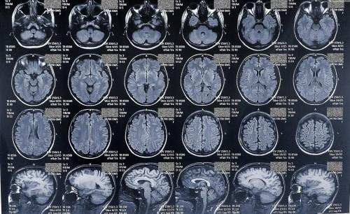 снимки МРТ головного мозга и гипофиза