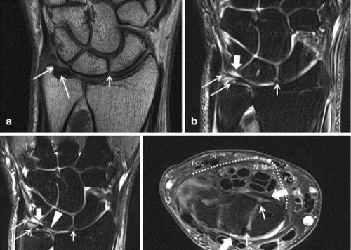 снимки МРТ лучезапястного сустава