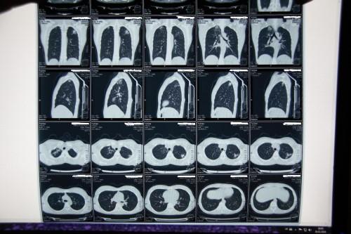 снимки КТ органов грудной клетки